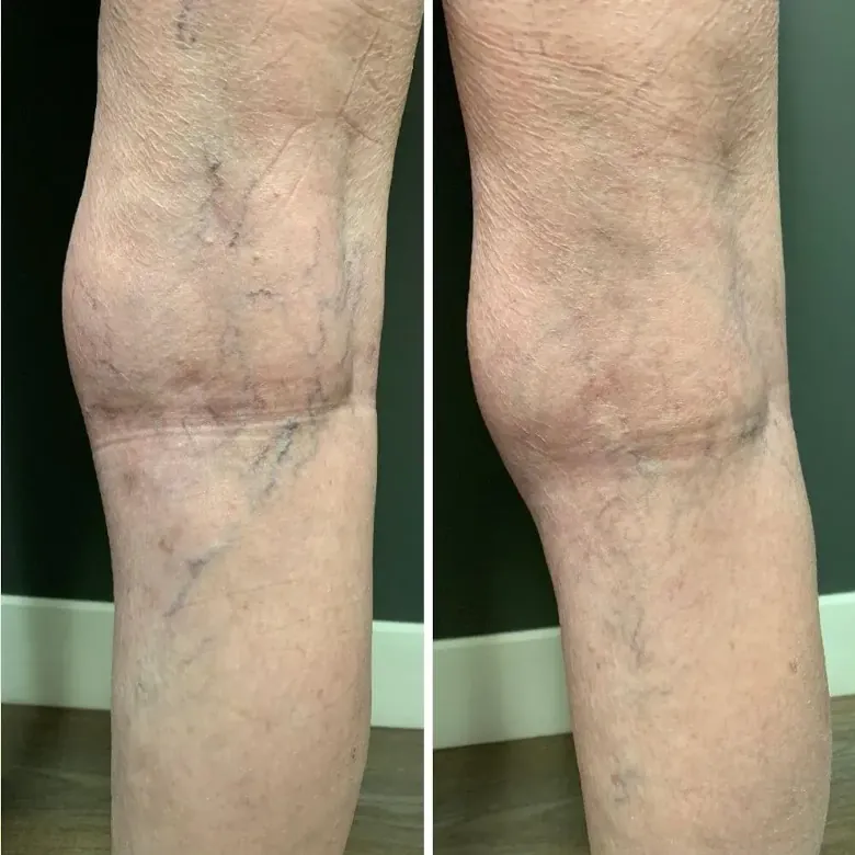 Фото ног: варикоз до и после лечения